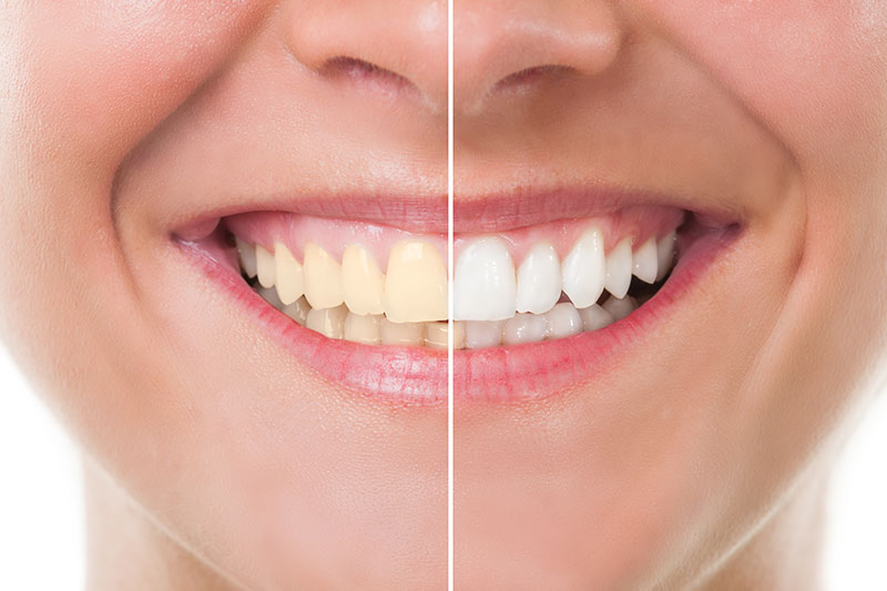 Teeth Whitening in Henderson